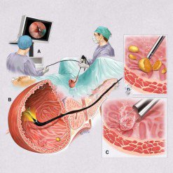 Cystoscopy_medical_illustration-247x247
