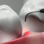 dental-laser-chicago-980x360