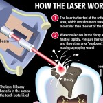 laser-dentistry1