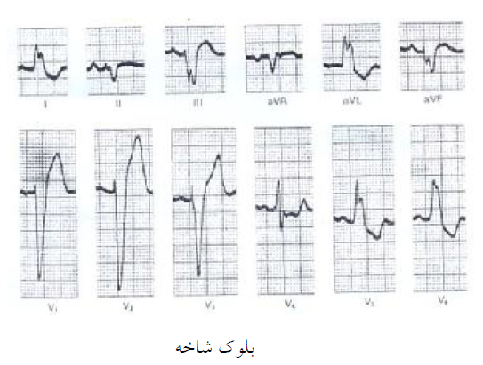 خصوصیات بلوك شاخه چپ-مدرسه مهندسی پزشکی ایران